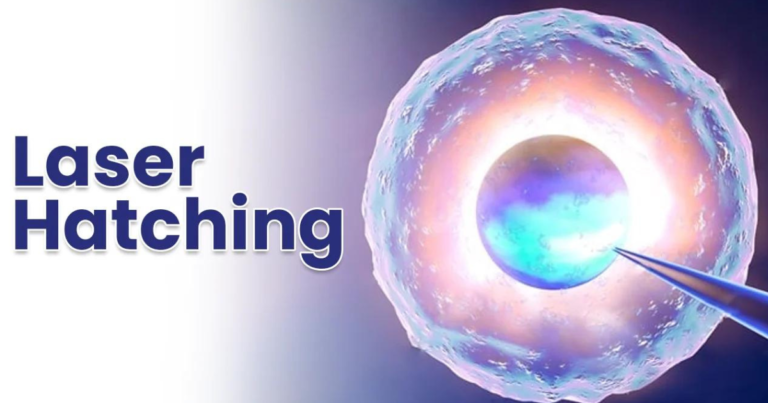 Laser Hatching - Shivam IVF